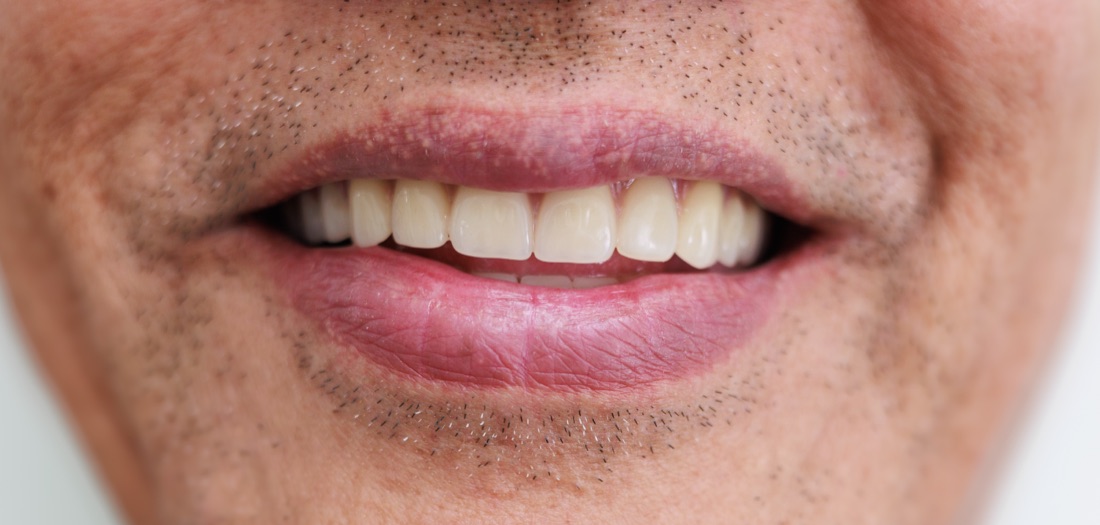 After: implant-supported dentures restored a full, natural smile