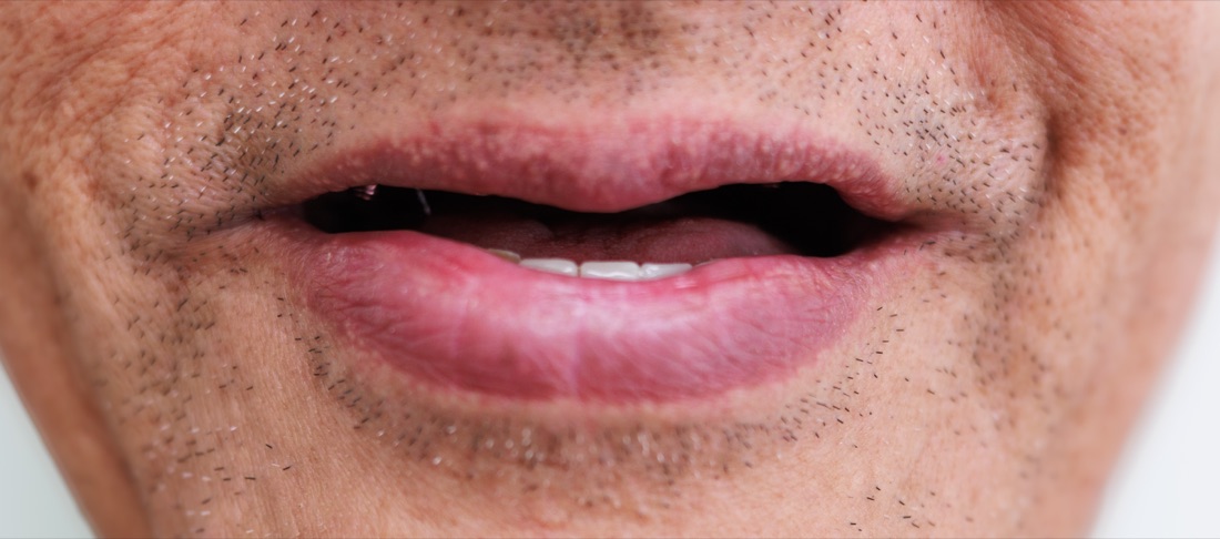 Before: missing upper and lower teeth