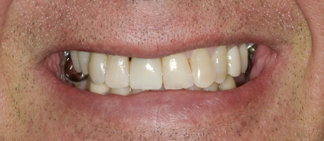 After: This patient replaced a missing front tooth with a dental implant. The new tooth blends in naturally and makes it easier to smile without second guessing it.