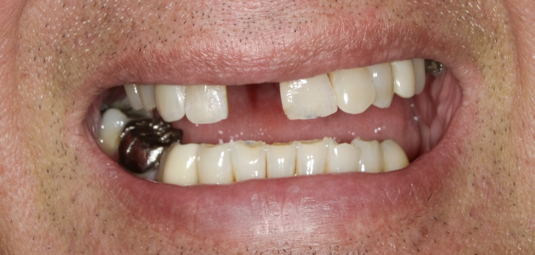 Before: This patient replaced a missing front tooth with a dental implant. The new tooth blends in naturally and makes it easier to smile without second guessing it.