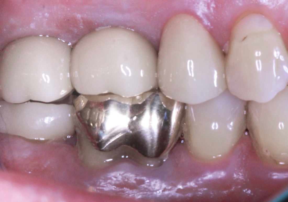 After: This patient was missing two back teeth, which made chewing more difficult and left gaps in their smile. Dental implants restored both strength and function.