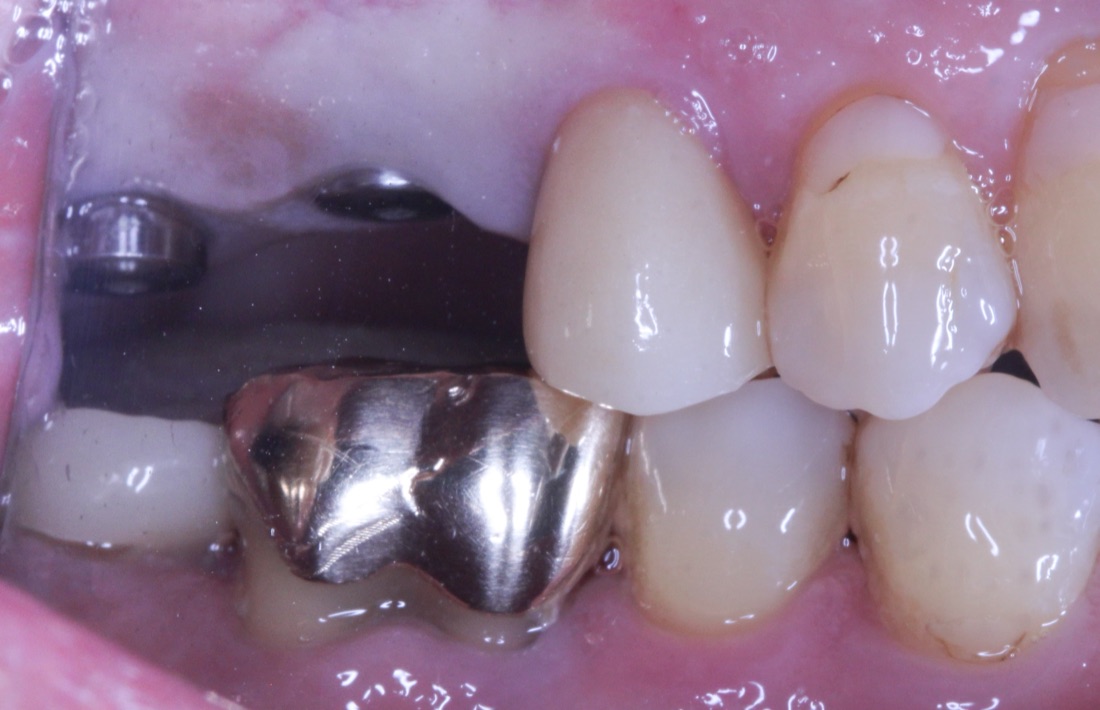 Before: This patient was missing two back teeth, which made chewing more difficult and left gaps in their smile. Dental implants restored both strength and function.