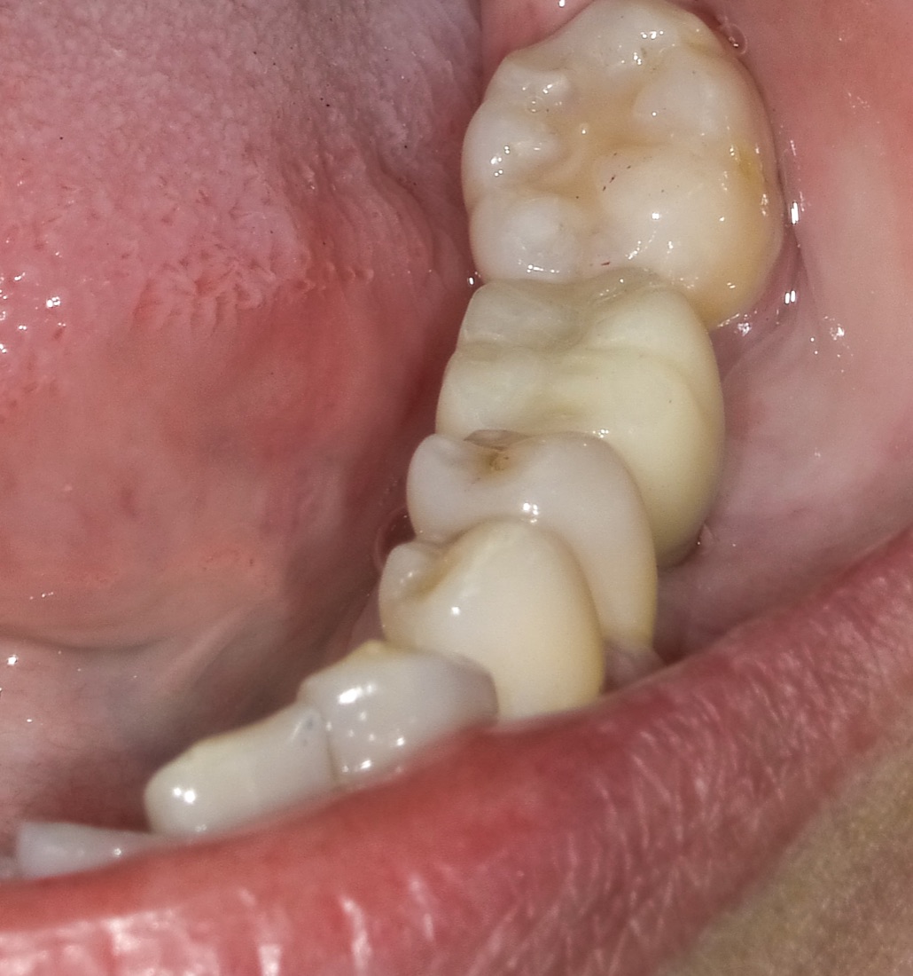After: This patient came to us with a missing back tooth that made chewing difficult. A dental implant replaced the missing molar and restored normal function.