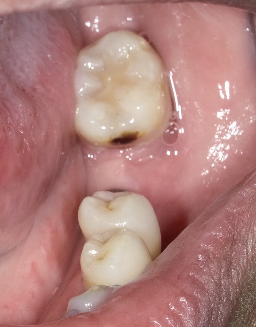 Before: This patient came to us with a missing back tooth that made chewing difficult. A dental implant replaced the missing molar and restored normal function.