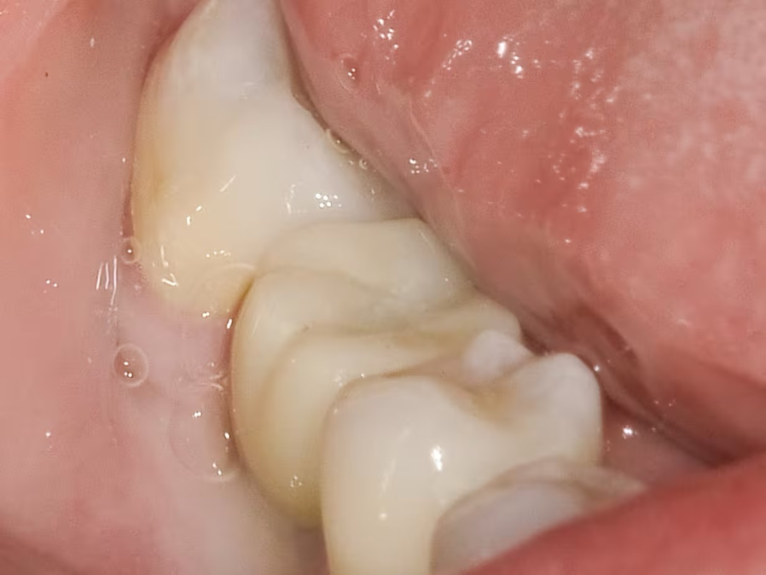 After: After losing a back tooth, this patient had trouble eating on one side. A dental implant restored their smile’s strength and balance.