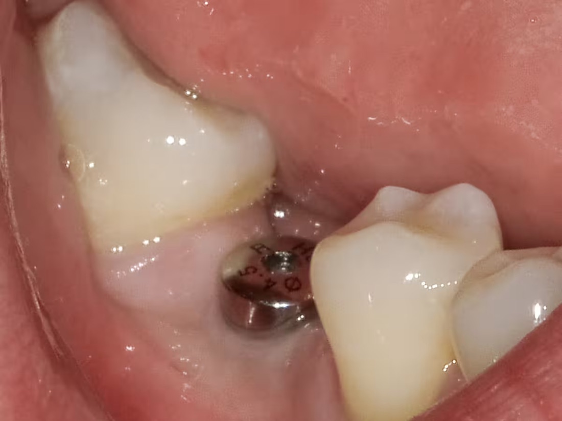 Before: After losing a back tooth, this patient had trouble eating on one side. A dental implant restored their smile’s strength and balance.