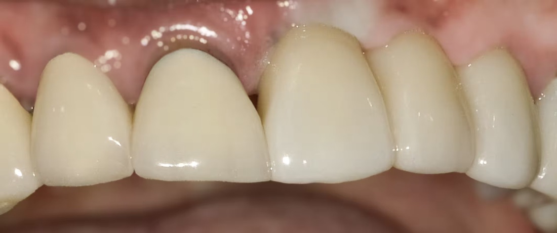 After: After losing two front teeth, this patient wanted to bring their smile back to life. Custom dental implants restored their natural look.