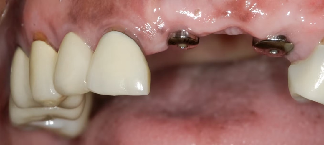 Before: After losing two front teeth, this patient wanted to bring their smile back to life. Custom dental implants restored their natural look.