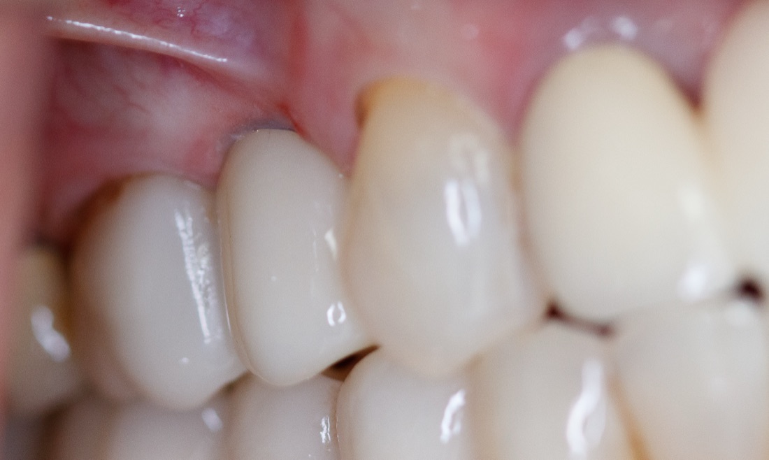 After: This patient replaced a missing tooth with a dental implant designed to look, feel, and function like a natural tooth. The result is a strong, seamless smile.