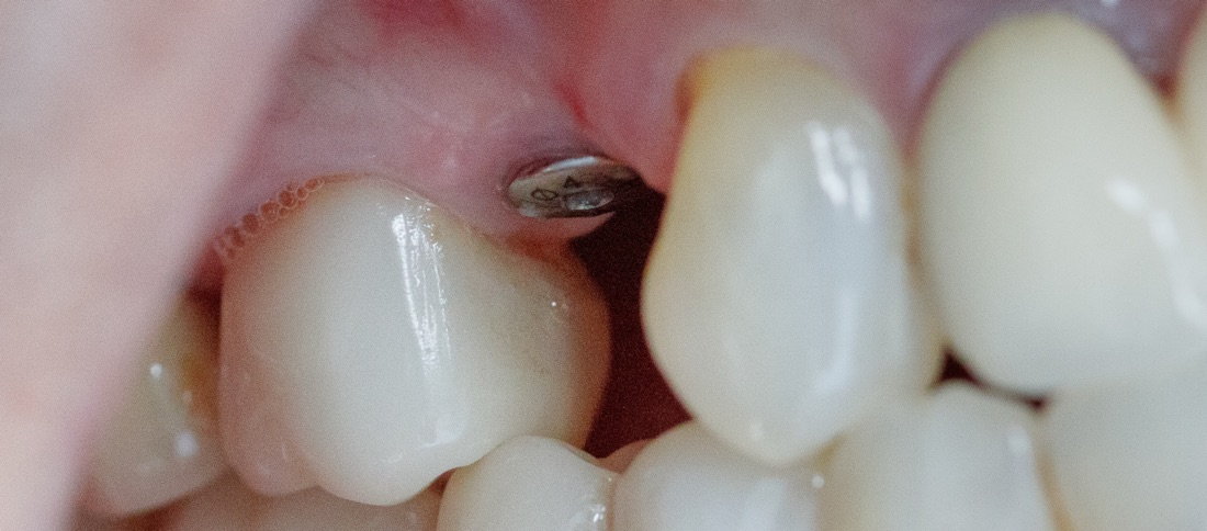 Before: This patient replaced a missing tooth with a dental implant designed to look, feel, and function like a natural tooth. The result is a strong, seamless smile.