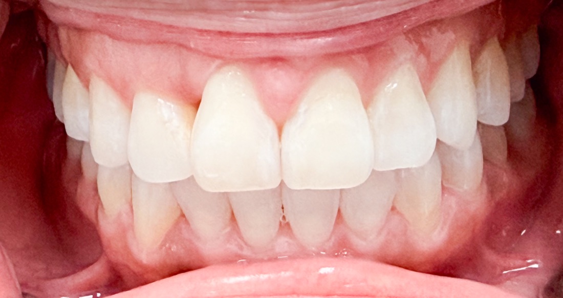 After: This patient straightened their teeth using Invisalign clear aligners for a more balanced, confident smile. No metal braces needed.