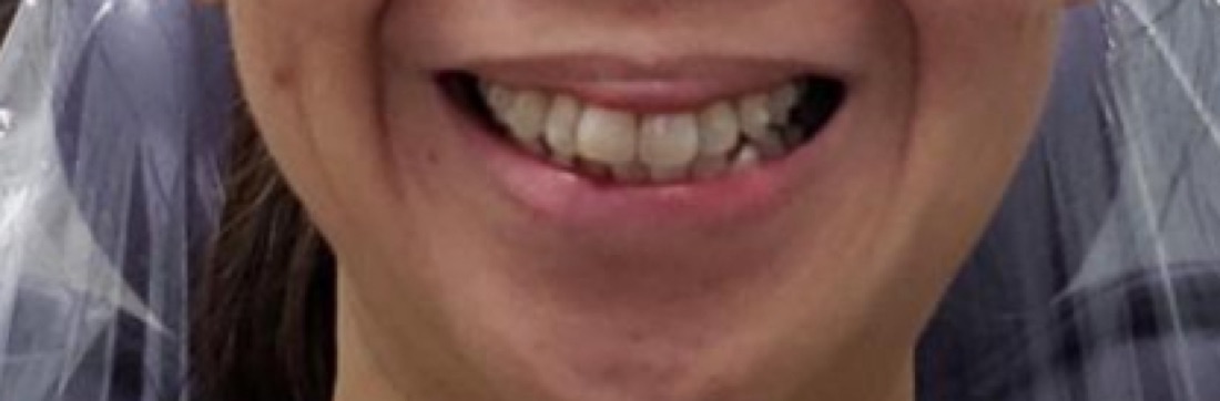 Before: This patient straightened their teeth using Invisalign clear aligners for a more balanced, confident smile. No metal braces needed.