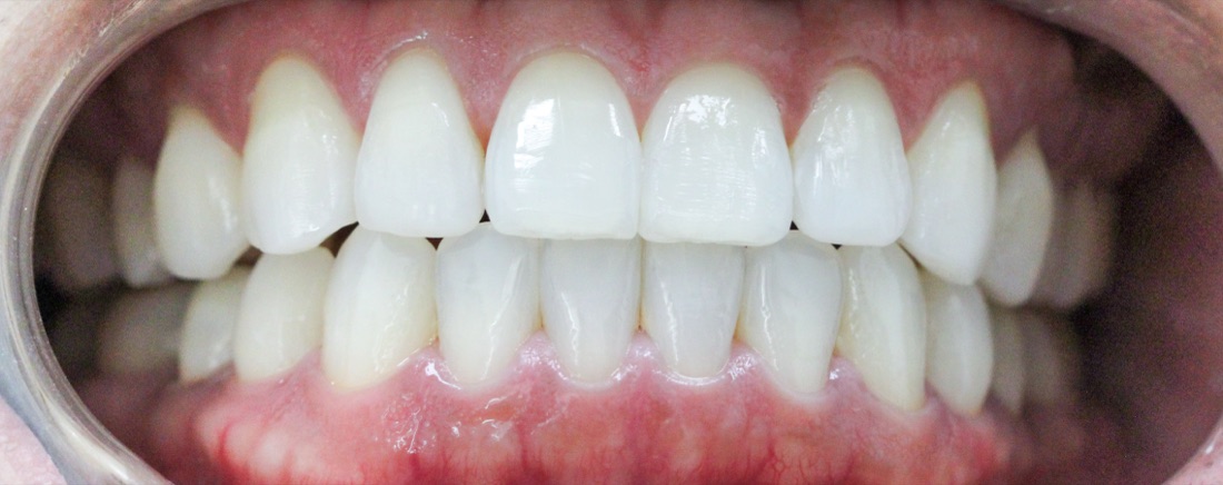 After: This patient used Invisalign clear aligners to straighten teeth that were crowded and uneven, gently guided into a more even position over time.