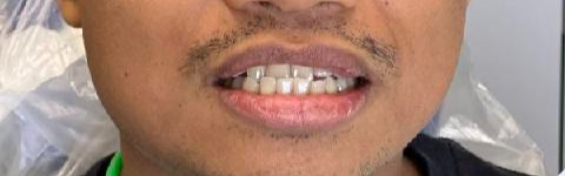 Before: This patient used Invisalign clear aligners to straighten teeth that were crowded and uneven, gently guided into a more even position over time.