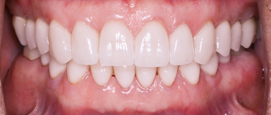 After: This full mouth makeover completely transformed the patient’s smile, improving both appearance and function through a customized treatment plan.