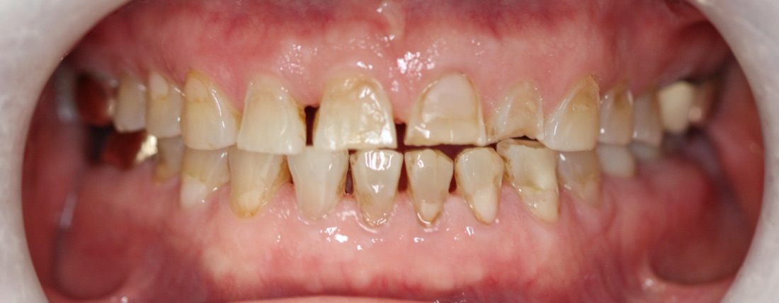 Before: This full mouth makeover completely transformed the patient’s smile, improving both appearance and function through a customized treatment plan.
