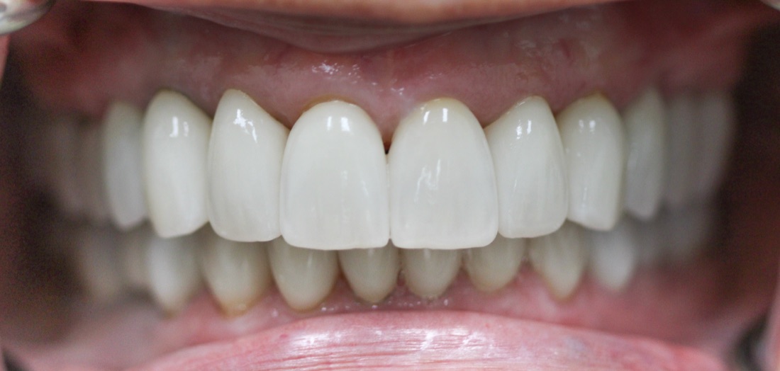 After: This patient received a full mouth makeover to address teeth that were worn and uneven, restoring comfort and creating teeth that look natural.