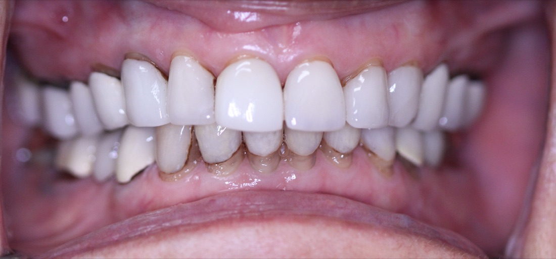 Before: This patient received a full mouth makeover to address teeth that were worn and uneven, restoring comfort and creating teeth that look natural.