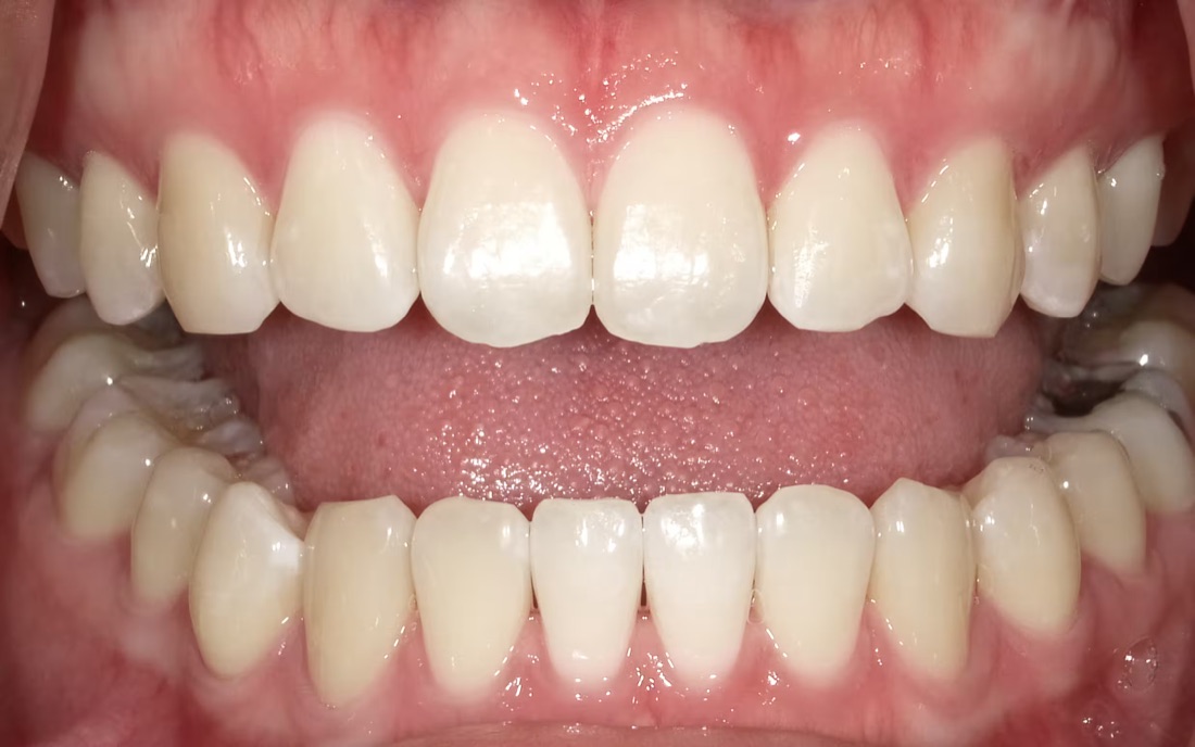 After: This patient wanted a brighter, more radiant smile. Our professional in-office whitening lifted years of surface stains in just one visit.