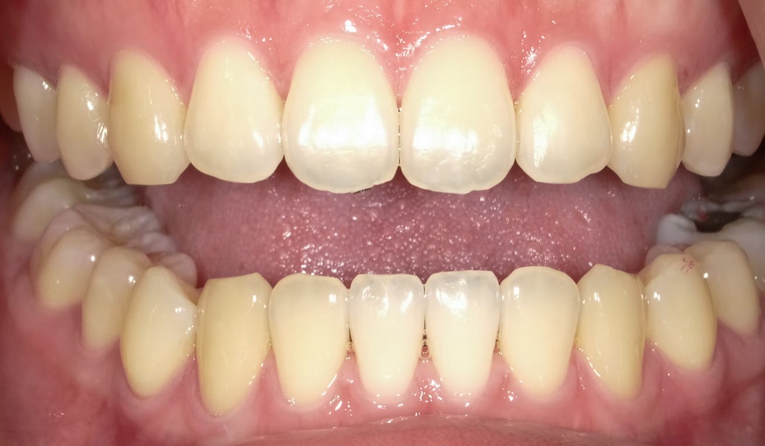 Before: This patient wanted a brighter, more radiant smile. Our professional in-office whitening lifted years of surface stains in just one visit.