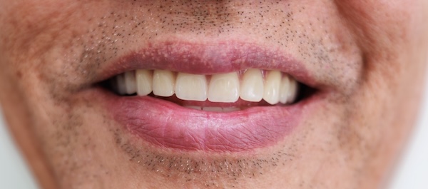 After: implant-supported dentures restored a full, natural smile