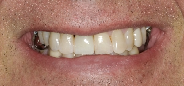After: dental implant replaced the missing front tooth