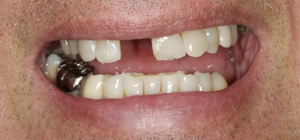 Before: missing front tooth
