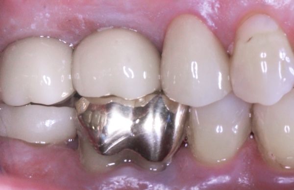 After: dental implants restored the missing back teeth