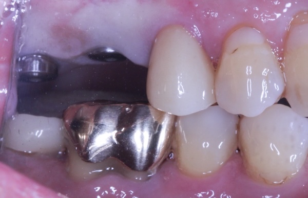 Before: missing two back teeth