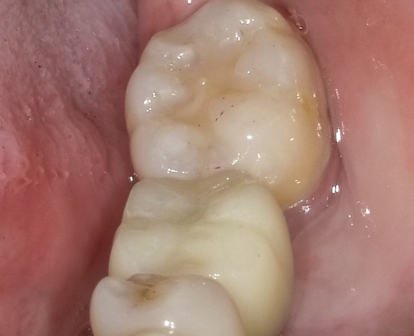 After: dental implant replaced the missing molar