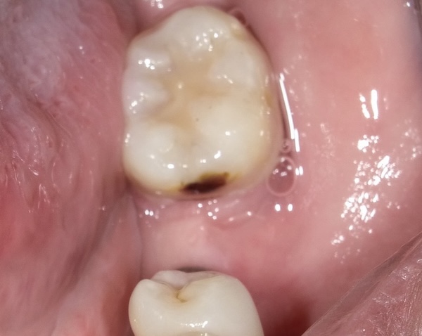 Before: missing back molar