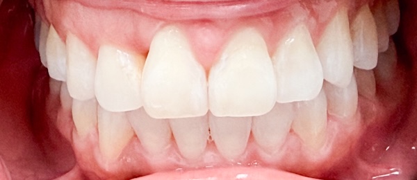 After: straighter smile after Invisalign treatment