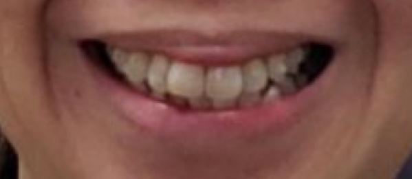 Before: crowded teeth before Invisalign treatment