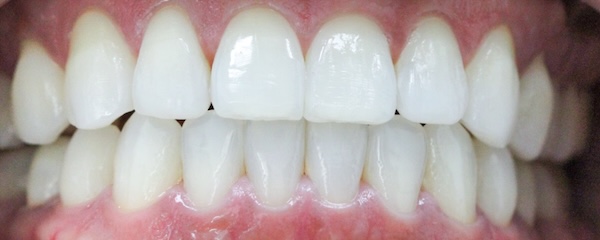 After: even, aligned smile after Invisalign treatment