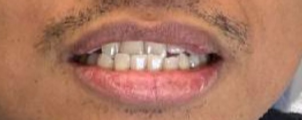 Before: crowded and uneven teeth before Invisalign treatment