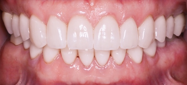After: full mouth makeover restored the smile
