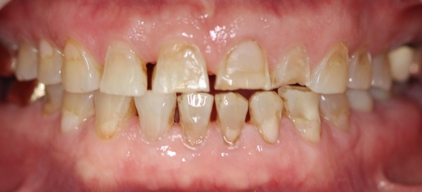 Before: full mouth makeover treatment