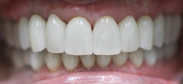After: full mouth makeover created a natural, even smile
