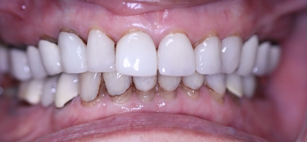 Before: worn and uneven teeth