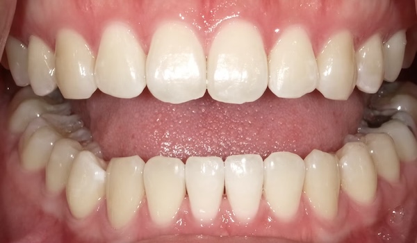 After: brighter smile following professional whitening