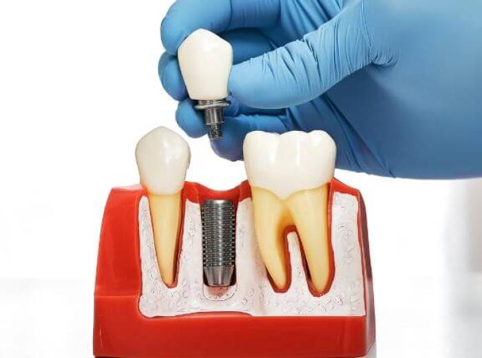 How Do Dental Implants Stay in Place? A Waipahu Guide