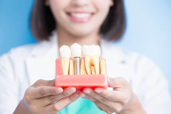 Dental Implants
